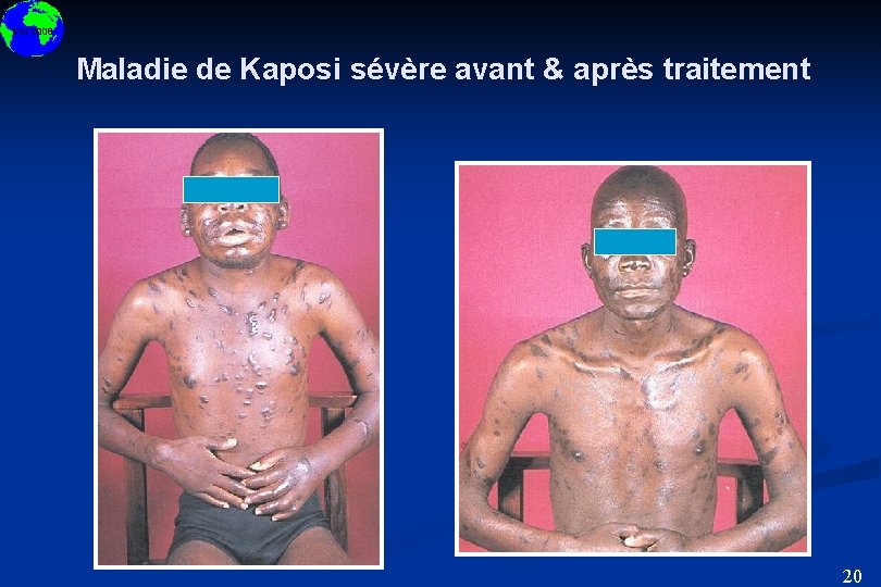 DIU 2008 Maladie de Kaposi sévère avant & après traitement 20 