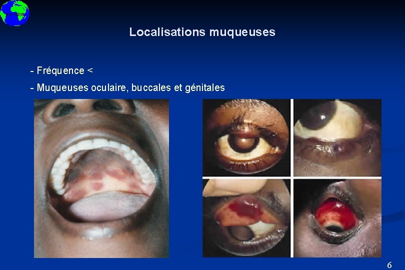 DIU 2008 Localisations muqueuses - Fréquence < - Muqueuses oculaire, buccales et génitales 6