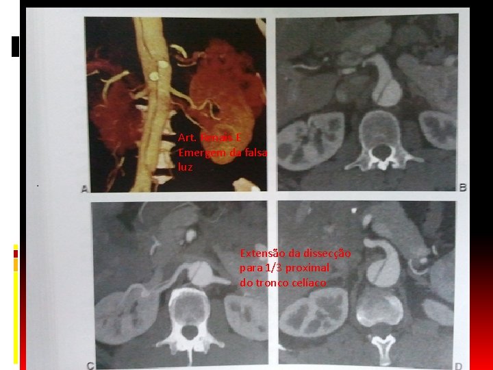 Art. Renais E Emergem da falsa luz Extensão da dissecção para 1/3 proximal do