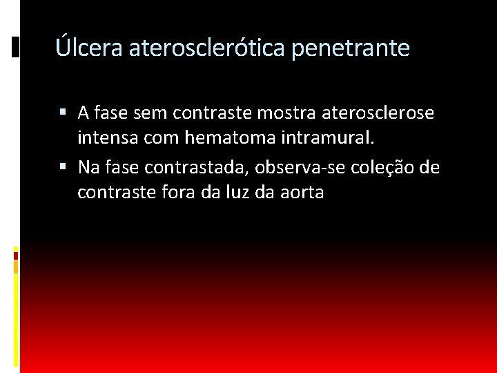 Úlcera aterosclerótica penetrante A fase sem contraste mostra aterosclerose intensa com hematoma intramural. Na