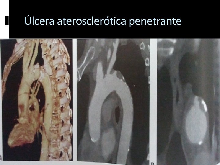 Úlcera aterosclerótica penetrante 