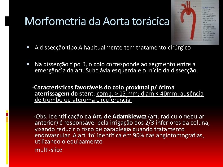 Morfometria da Aorta torácica A dissecção tipo A habitualmente tem tratamento cirúrgico Na dissecção