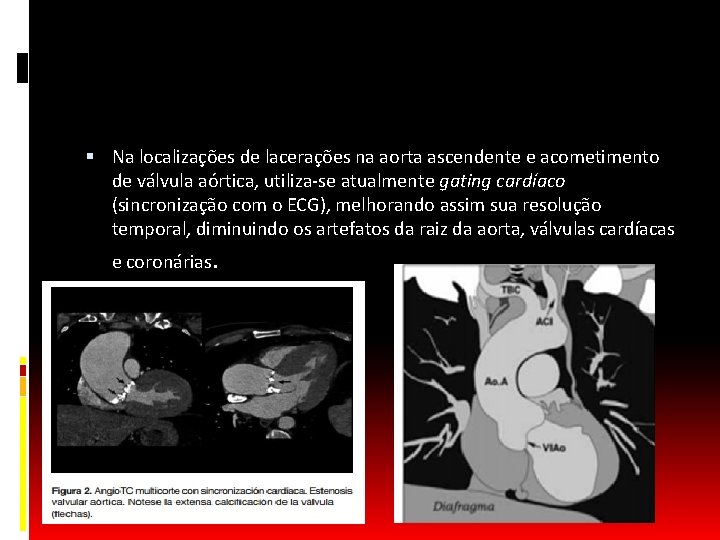  Na localizações de lacerações na aorta ascendente e acometimento de válvula aórtica, utiliza-se