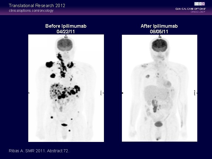 Translational Research 2012 clinicaloptions. com/oncology Before Ipilimumab 04/22/11 Ribas A. SMR 2011. Abstract 72.