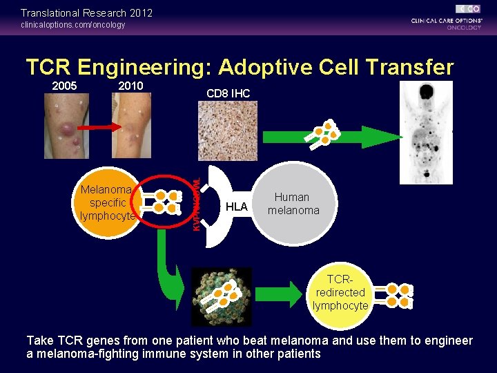 Translational Research 2012 clinicaloptions. com/oncology TCR Engineering: Adoptive Cell Transfer 2010 Melanomaspecific lymphocyte CD