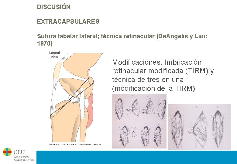 DISCUSIÓN EXTRACAPSULARES Sutura fabelar lateral; técnica retinacular (De. Angelis y Lau; 1970) Modificaciones: Imbricación