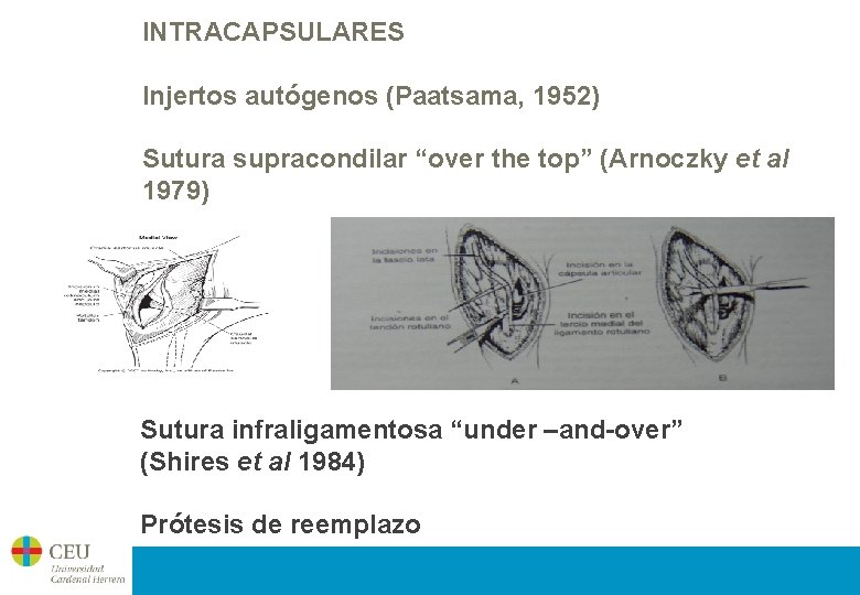 INTRACAPSULARES Injertos autógenos (Paatsama, 1952) Sutura supracondilar “over the top” (Arnoczky et al 1979)