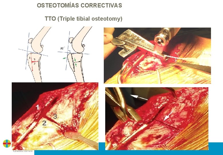 OSTEOTOMÍAS CORRECTIVAS TTO (Triple tibial osteotomy) 16 