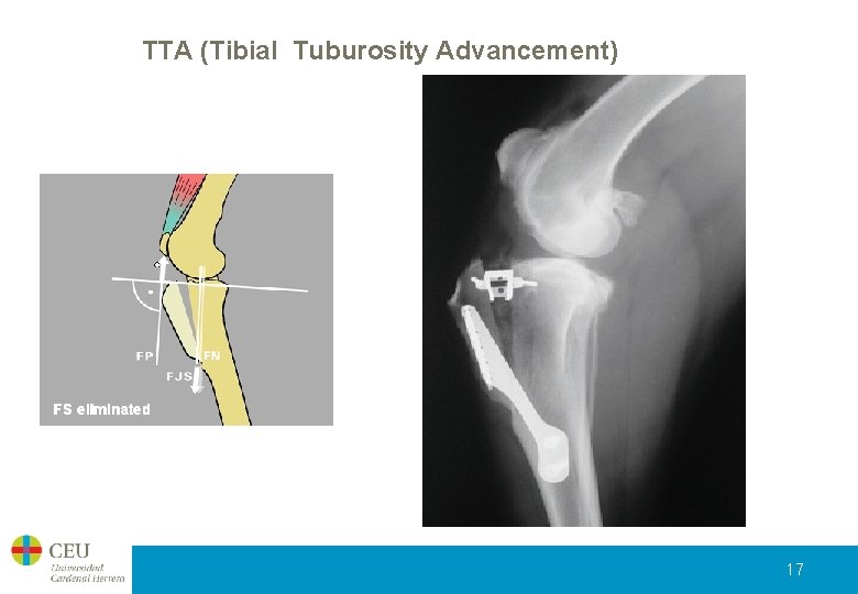 TTA (Tibial Tuburosity Advancement) 17 