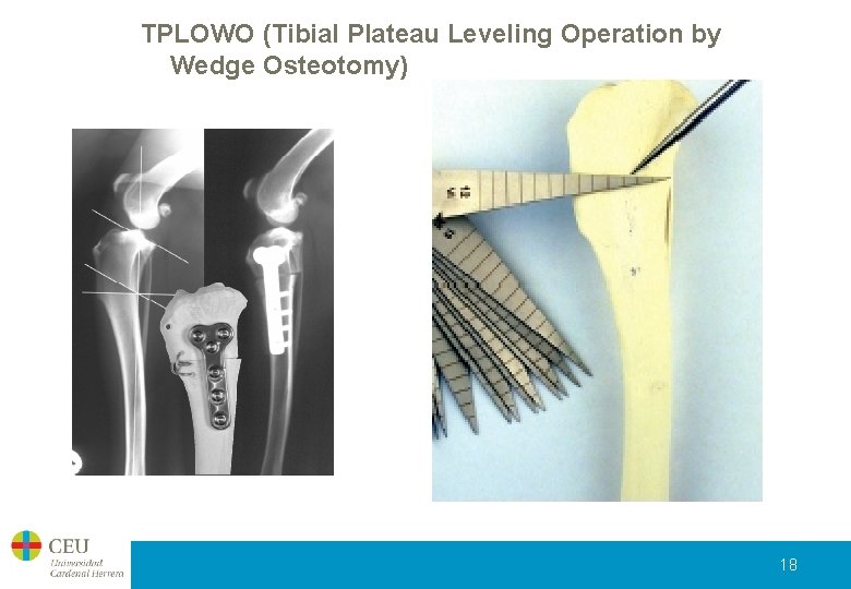 TPLOWO (Tibial Plateau Leveling Operation by Wedge Osteotomy) 18 