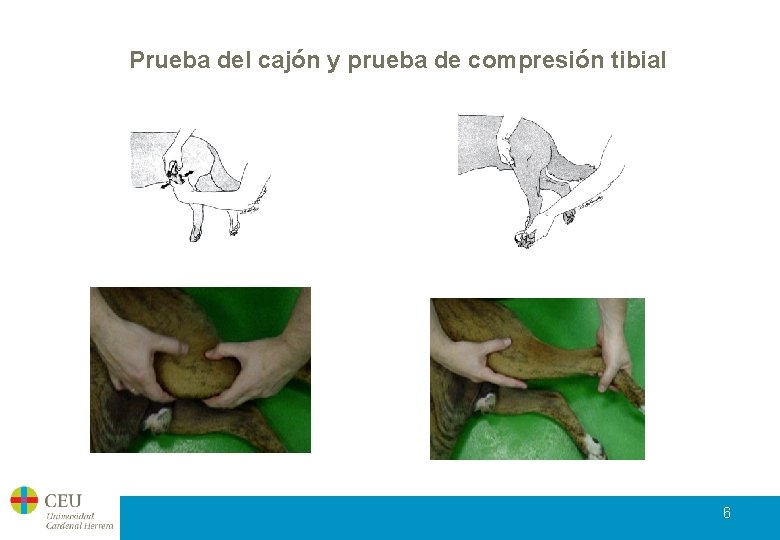 Prueba del cajón y prueba de compresión tibial 6 