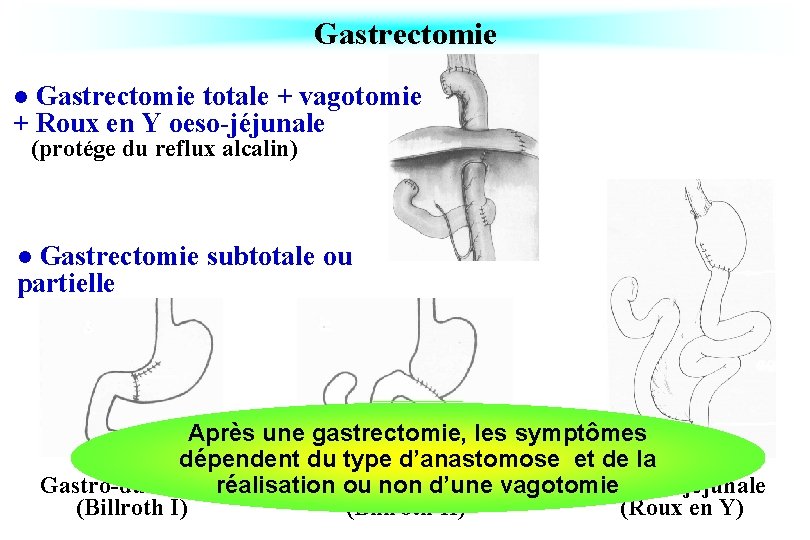 Gastrectomie totale + vagotomie + Roux en Y oeso-jéjunale l (protége du reflux alcalin)