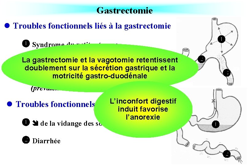Gastrectomie l Troubles fonctionnels liés à la gastrectomie Syndrome du petit estomac La gastrectomie