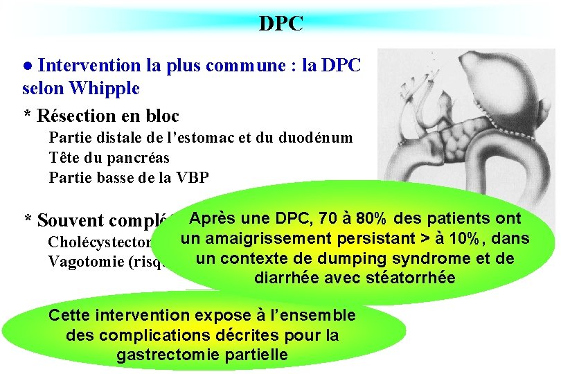 DPC Intervention la plus commune : la DPC selon Whipple * Résection en bloc