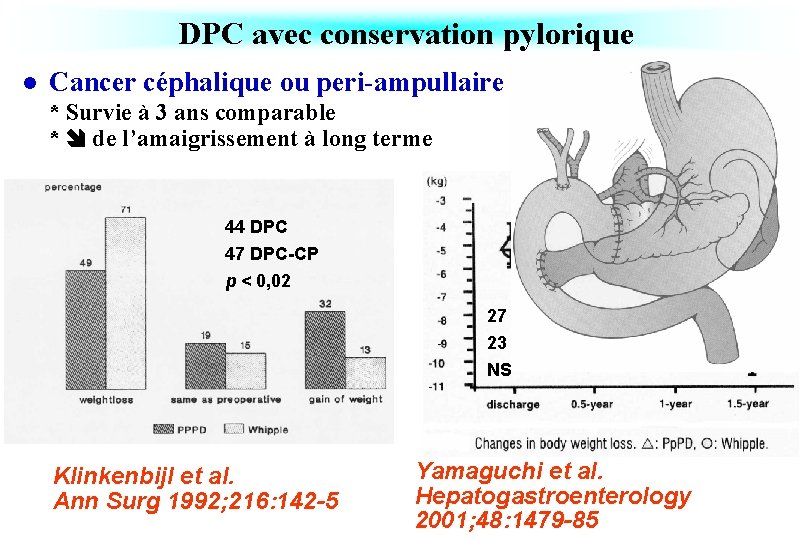 DPC avec conservation pylorique l Cancer céphalique ou peri-ampullaire * Survie à 3 ans