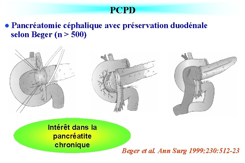 PCPD l Pancréatomie céphalique avec préservation duodénale selon Beger (n > 500) Intérêt dans