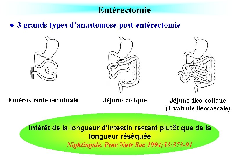 Entérectomie l 3 grands types d’anastomose post-entérectomie Entérostomie terminale Jéjuno-colique Jéjuno-iléo-colique ( valvule iléocaecale)
