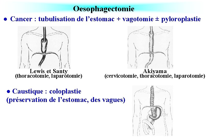 Oesophagectomie l Cancer : tubulisation de l’estomac + vagotomie ± pyloroplastie Lewis et Santy