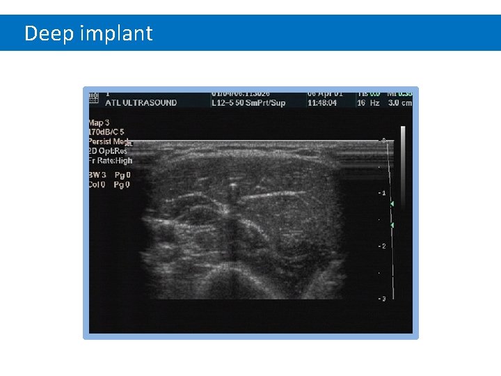 Deep implant 