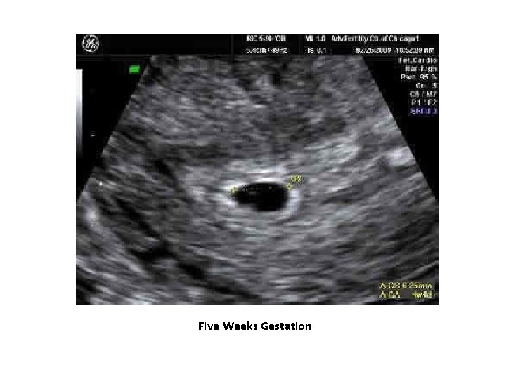 Five Weeks Gestation 
