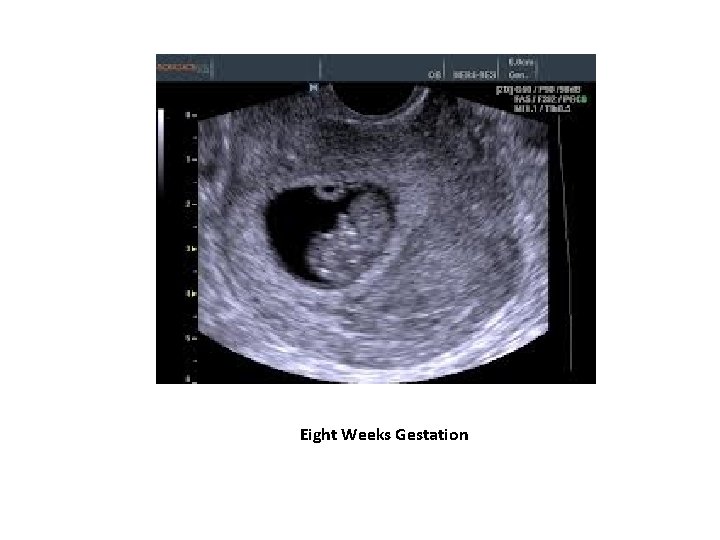 Eight Weeks Gestation 