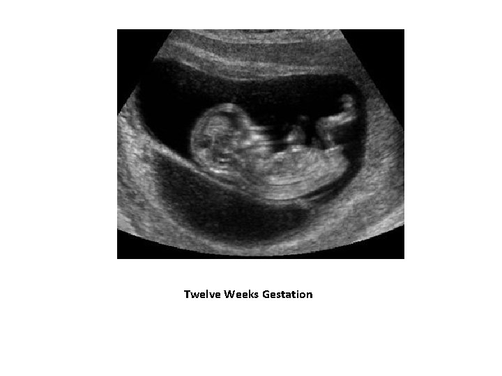 Twelve Weeks Gestation 