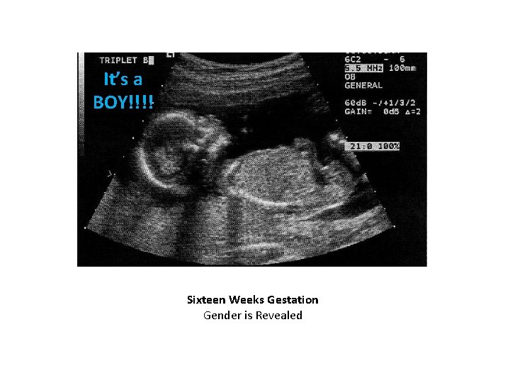 It’s a BOY!!!! Sixteen Weeks Gestation Gender is Revealed 