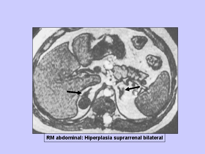 RM abdominal: Hiperplasia suprarrenal bilateral 