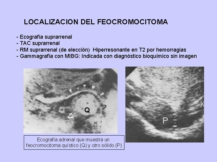 LOCALIZACION DEL FEOCROMOCITOMA - Ecografía suprarrenal - TAC suprarrenal - RM suprarrenal (de elección)