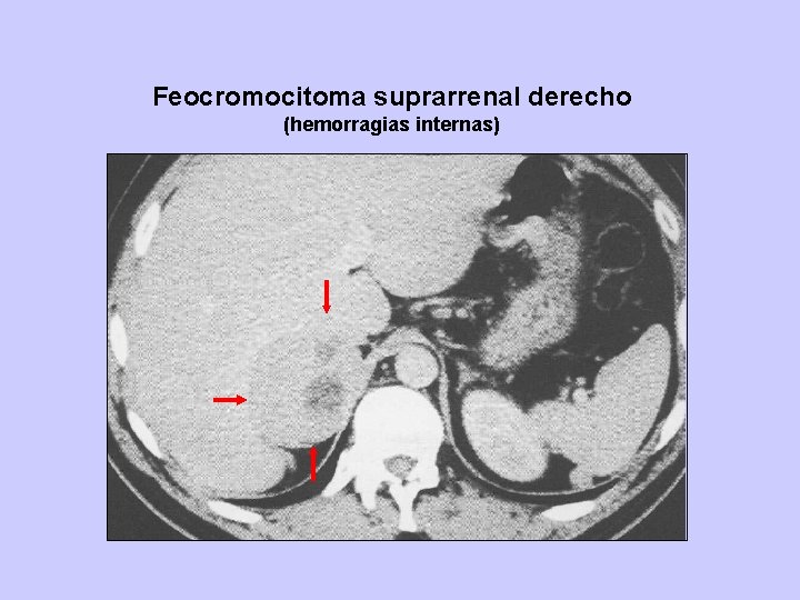 Feocromocitoma suprarrenal derecho (hemorragias internas) 