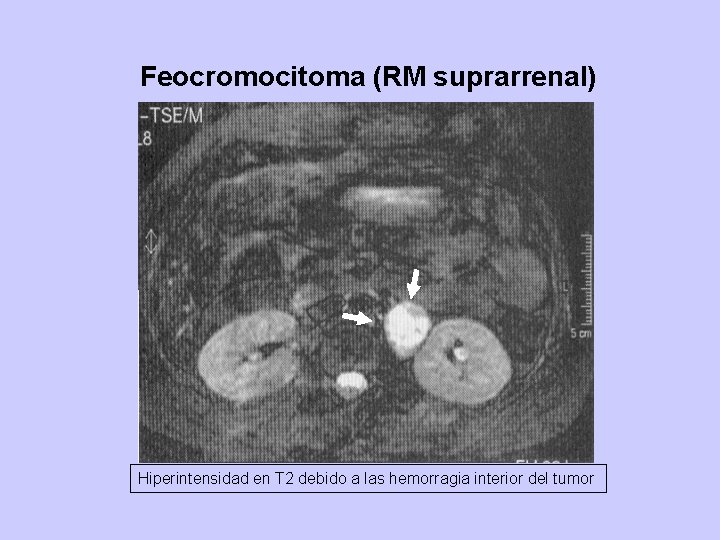 Feocromocitoma (RM suprarrenal) Hiperintensidad en T 2 debido a las hemorragia interior del tumor