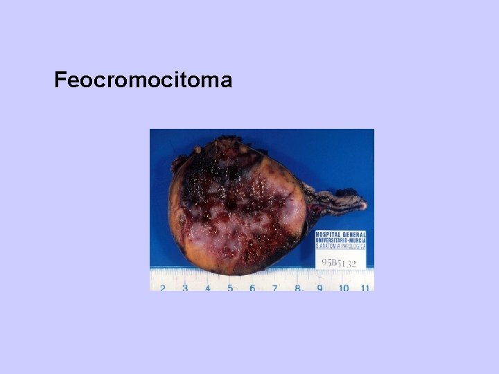 Feocromocitoma 