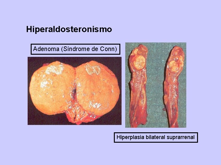 Hiperaldosteronismo Adenoma (Síndrome de Conn) Hiperplasia bilateral suprarrenal 