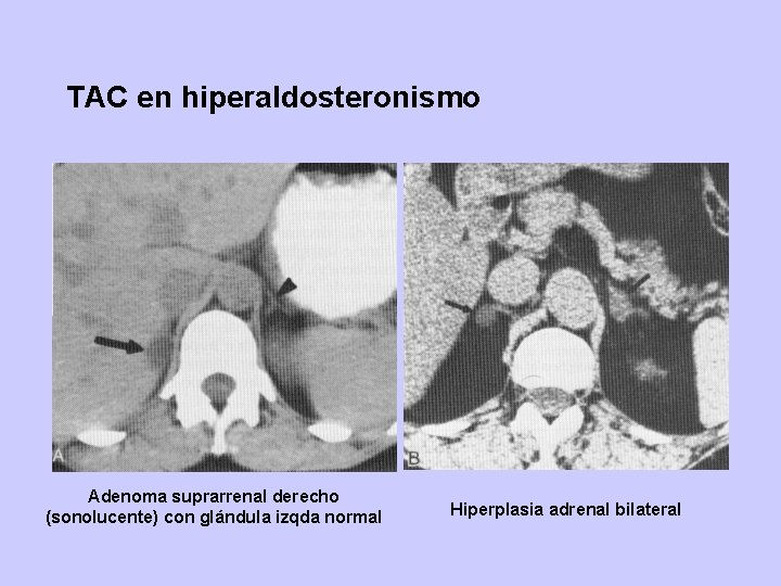 TAC en hiperaldosteronismo Adenoma suprarrenal derecho (sonolucente) con glándula izqda normal Hiperplasia adrenal bilateral