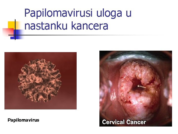 Papilomavirusi uloga u nastanku kancera Papilomavirus 