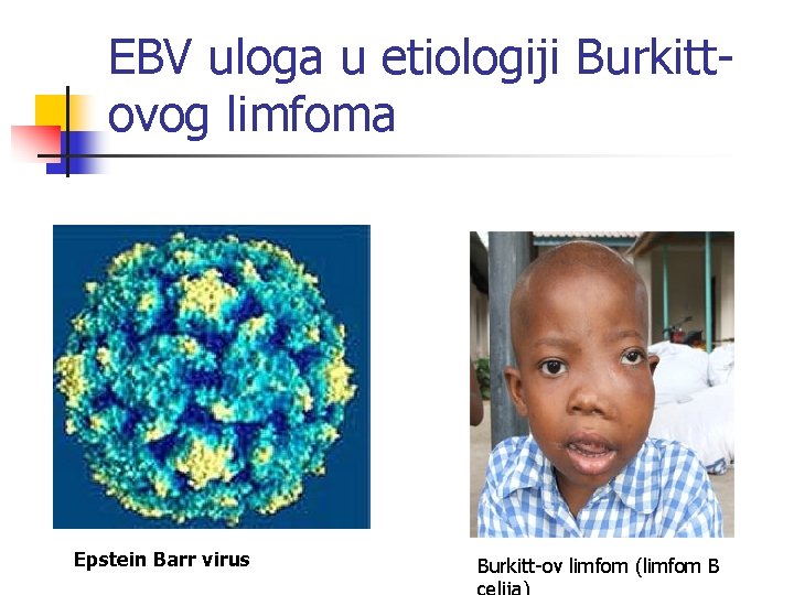 EBV uloga u etiologiji Burkittovog limfoma Epstein Barr virus Burkitt-ov limfom (limfom B 