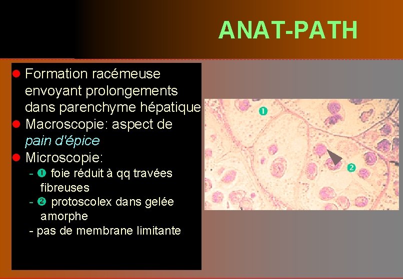 ANAT-PATH l Formation racémeuse envoyant prolongements dans parenchyme hépatique l Macroscopie: aspect de pain