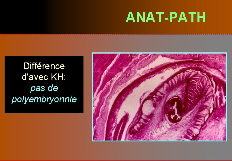 ANAT-PATH Différence d'avec KH: pas de polyembryonnie 