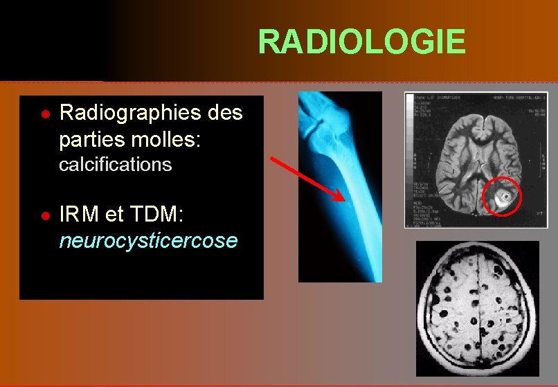 RADIOLOGIE l Radiographies des parties molles: calcifications l IRM et TDM: neurocysticercose 