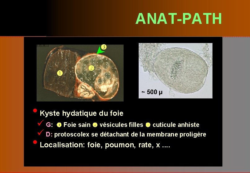 ANAT-PATH • Kyste hydatique du foie ü G: Foie sain vésicules filles cuticule anhiste