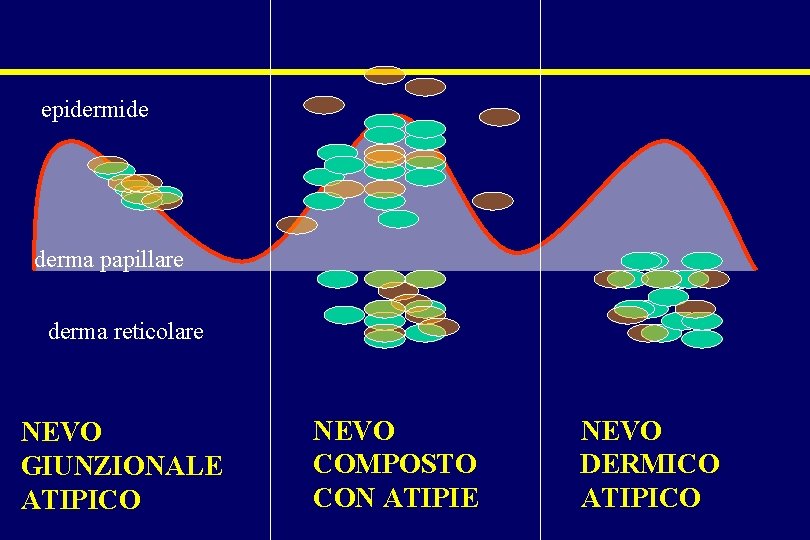 epidermide derma papillare derma reticolare NEVO GIUNZIONALE ATIPICO NEVO COMPOSTO CON ATIPIE NEVO DERMICO epidermide derma papillare derma reticolare NEVO GIUNZIONALE ATIPICO NEVO COMPOSTO CON ATIPIE NEVO DERMICO