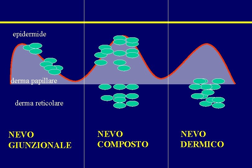 epidermide derma papillare derma reticolare NEVO GIUNZIONALE NEVO COMPOSTO NEVO DERMICO epidermide derma papillare derma reticolare NEVO GIUNZIONALE NEVO COMPOSTO NEVO DERMICO
