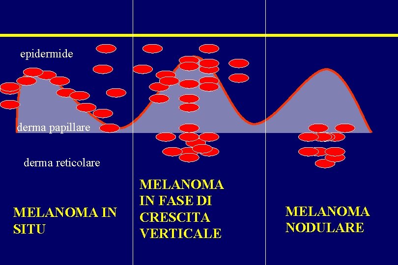 epidermide derma papillare derma reticolare MELANOMA IN SITU MELANOMA IN FASE DI CRESCITA VERTICALE epidermide derma papillare derma reticolare MELANOMA IN SITU MELANOMA IN FASE DI CRESCITA VERTICALE