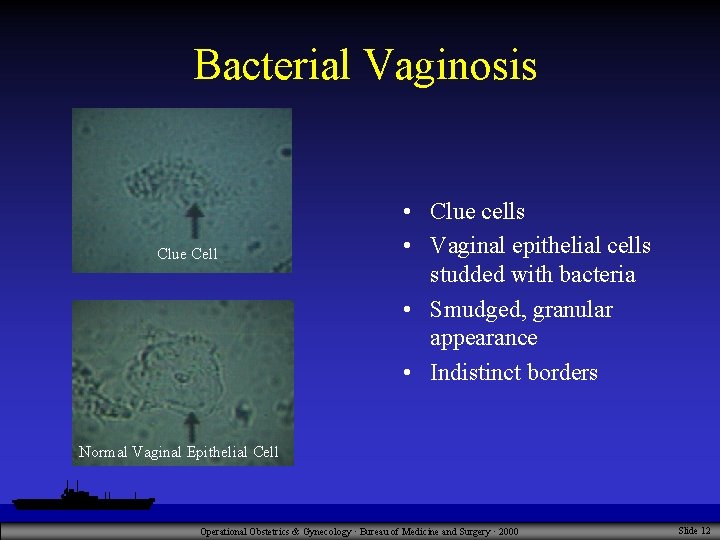 Bacterial Vaginosis Clue Cell • Clue cells • Vaginal epithelial cells studded with bacteria