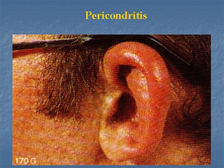 Pericondritis 