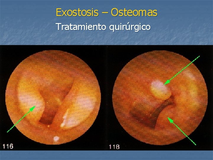 Exostosis – Osteomas Tratamiento quirúrgico 