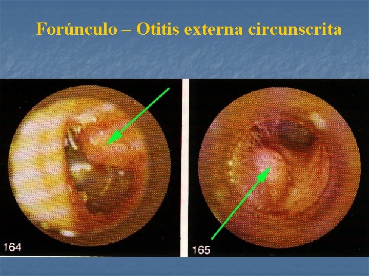 Forúnculo – Otitis externa circunscrita 