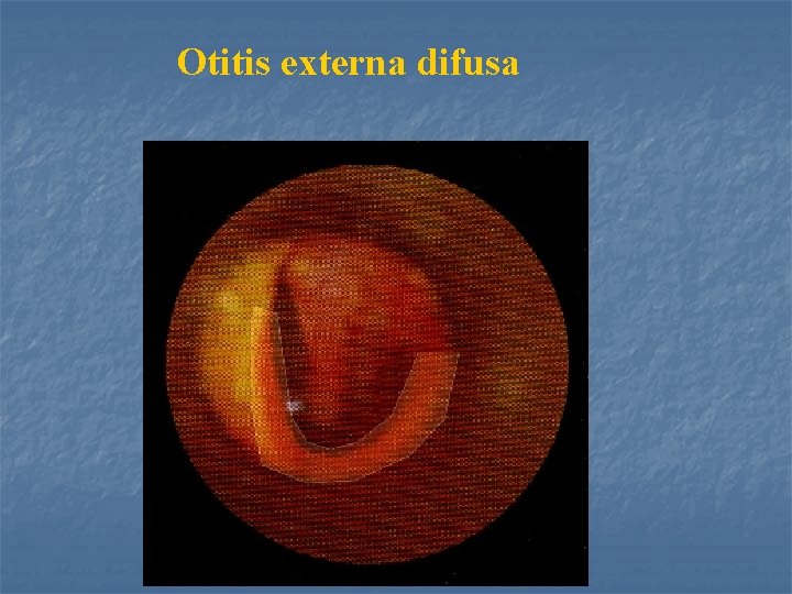 Otitis externa difusa 