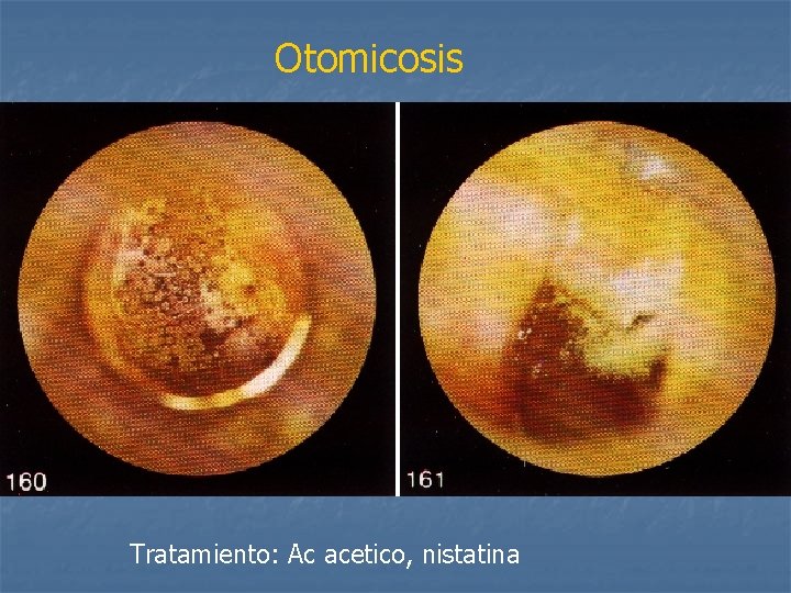 Otomicosis Tratamiento: Ac acetico, nistatina 