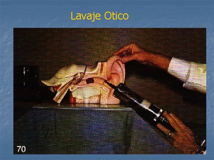 Lavaje Otico 